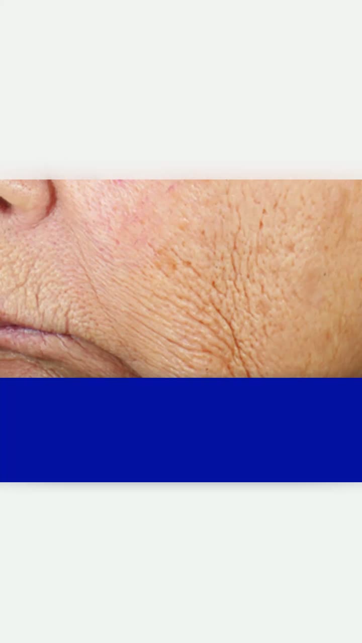 Wrinkle + Texture — before / after results (ZO®)